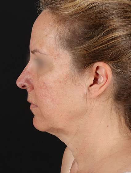 Face & Neck Lift Before & After Patient #3270