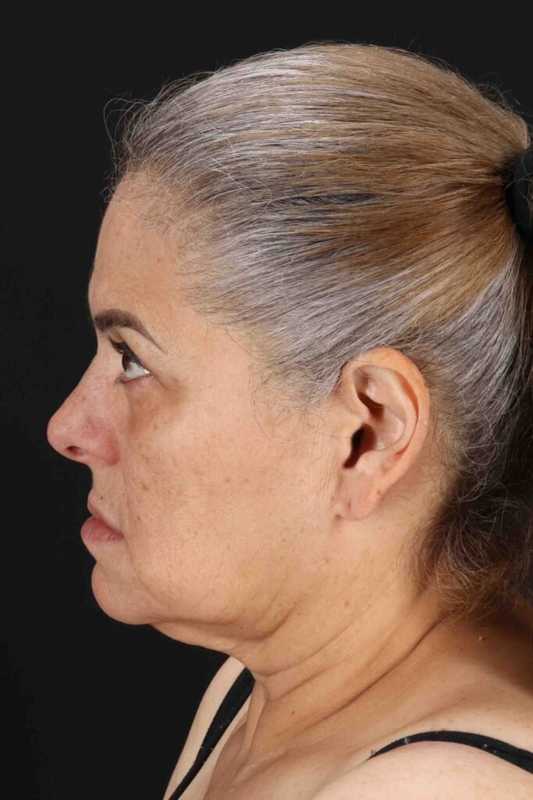 Face & Neck Lift Before & After Patient #3292