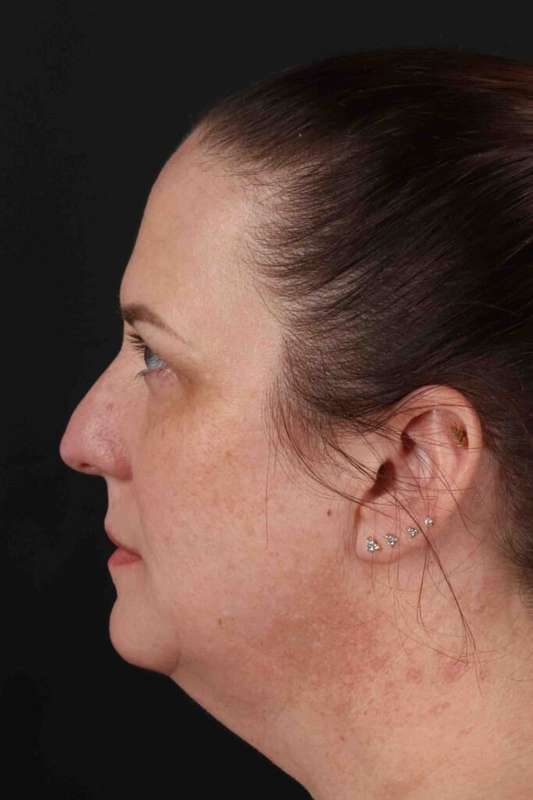 Face & Neck Lift Before & After Patient #3303