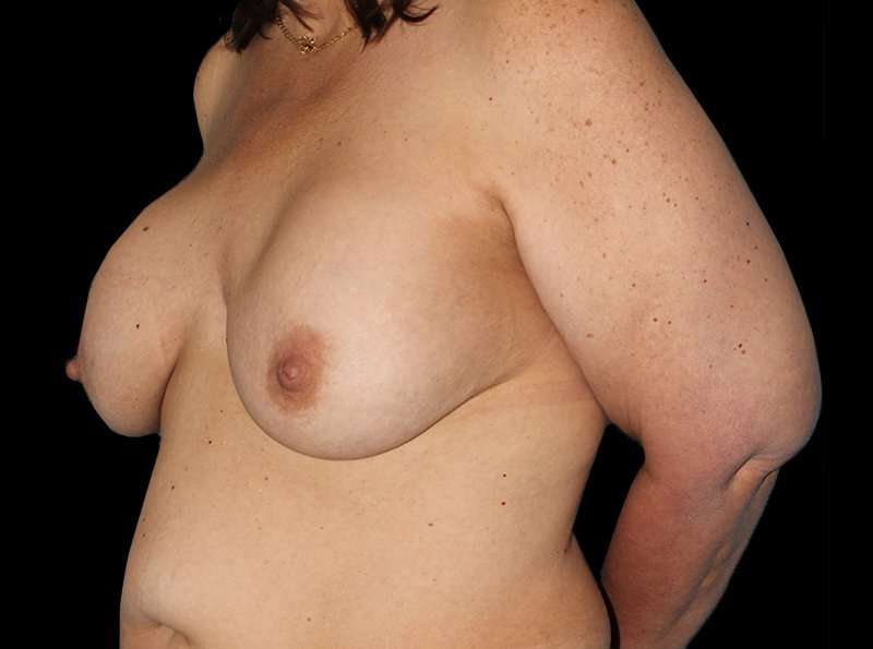 Revision Breast Surgery Before & After Patient #1195