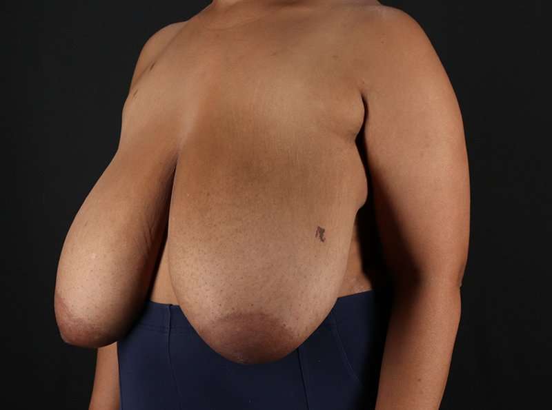 Breast Reduction Before & After Patient #1228