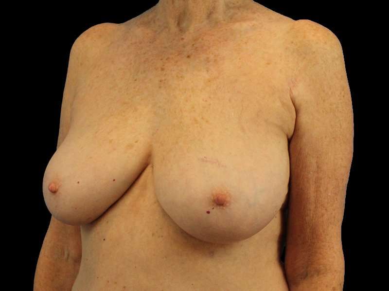 Breast Reduction Before & After Patient #1239