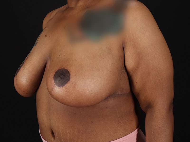 Breast Reduction Before & After Patient #1272