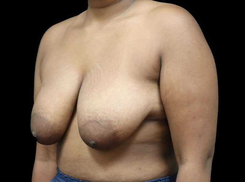 Breast Lift Before & After Patient #1343