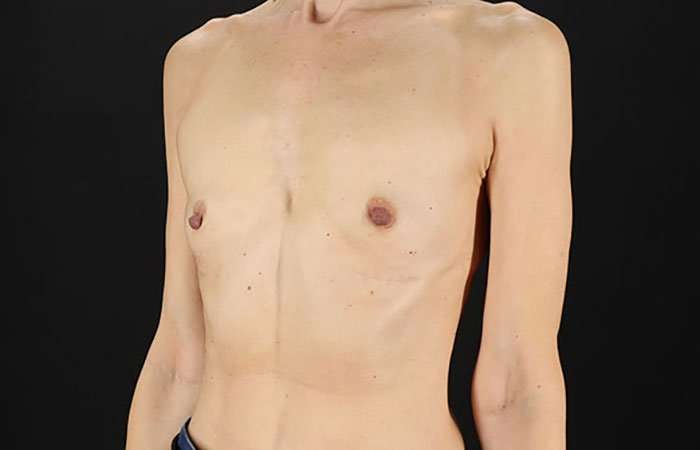 Breast Augmentation - Implant Before & After Patient #943