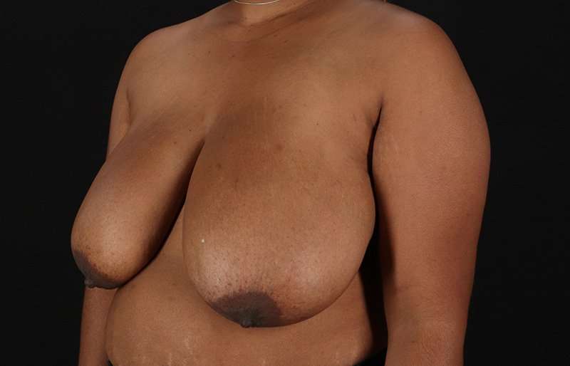 Breast Reduction Before & After Patient #1431