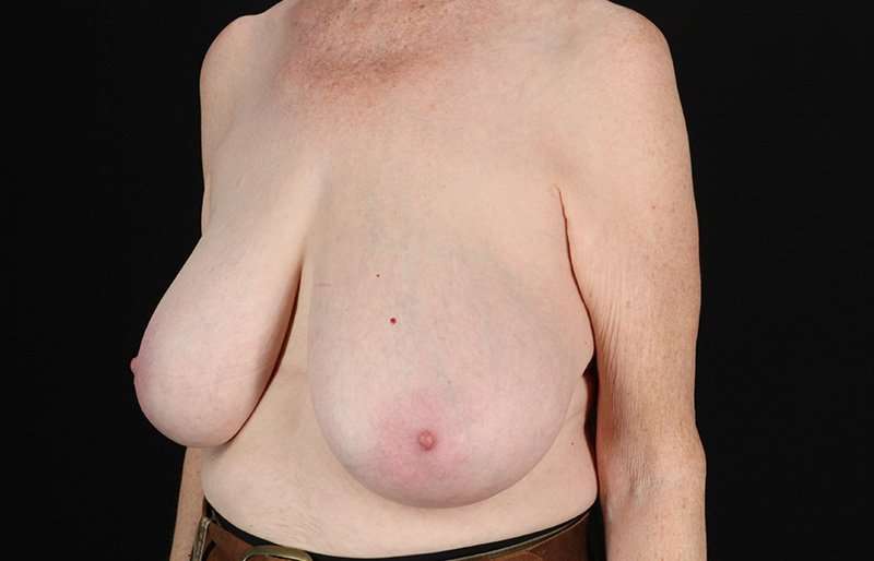 Breast Reduction Before & After Patient #1442
