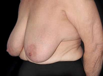 Breast Reduction Before & After Patient #1464