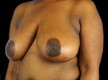 Breast Reduction Before & After Patient #1475