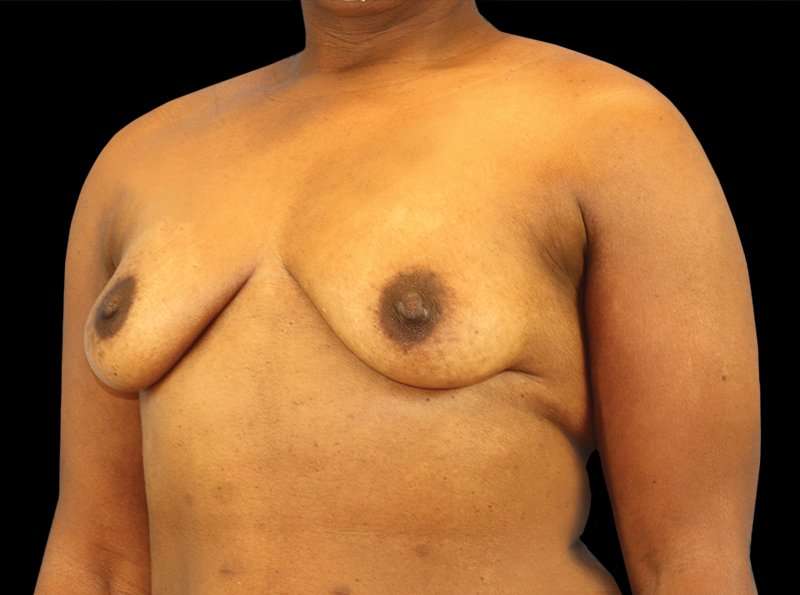 Breast Augmentation - Implant Before & After Patient #954