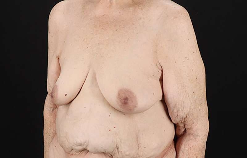 Augmentation/Lift Before & After Patient #1544