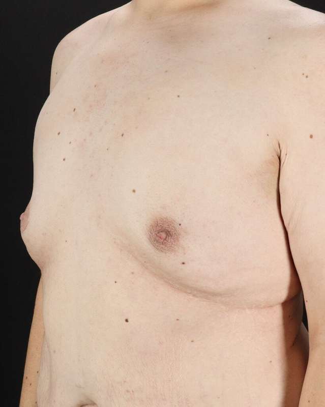 Gynecomastia Before & After Patient #1603