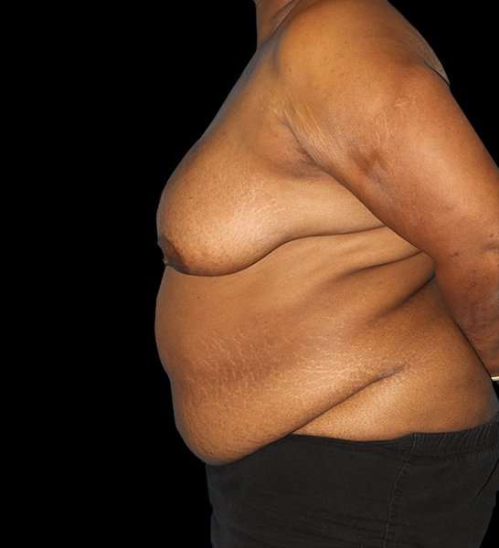 DIEP Flap Reconstruction Before & After Patient #1623