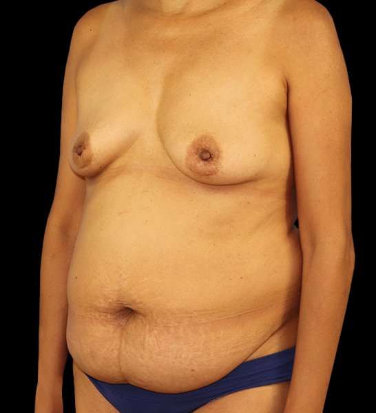 DIEP Flap Reconstruction Before & After Patient #1696