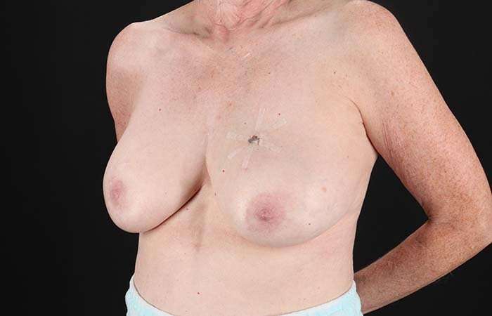 Implant Based Breast Reconstruction Before & After Patient #1718