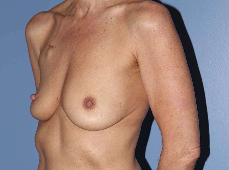 Implant Based Breast Reconstruction Before & After Patient #1729