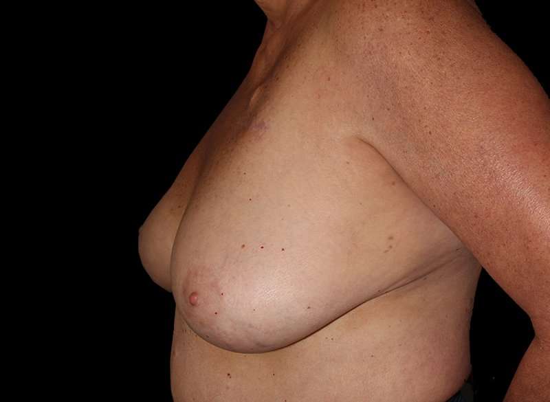 Oncoplastic Reconstruction Before & After Patient #1762