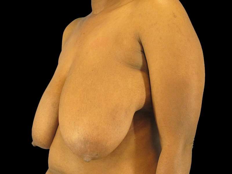 Oncoplastic Reconstruction Before & After Patient #1784