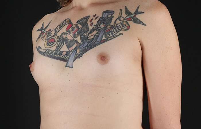 MTF Breast Augmentation Before & After Patient #1795
