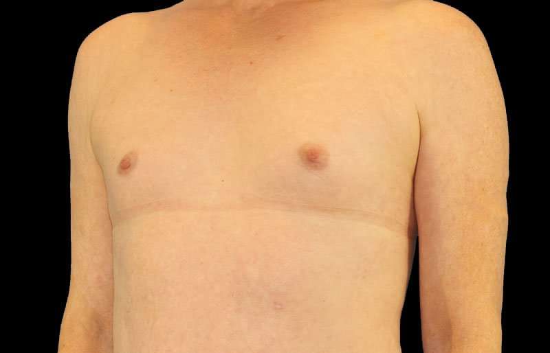 MTF Breast Augmentation Before & After Patient #1820