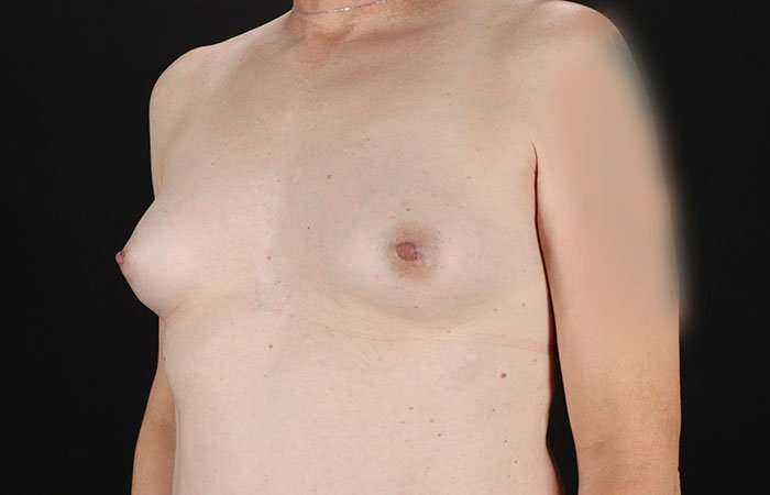 MTF Breast Augmentation Before & After Patient #1831