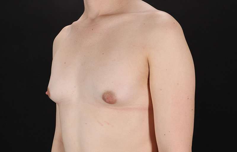 MTF Breast Augmentation Before & After Patient #1842