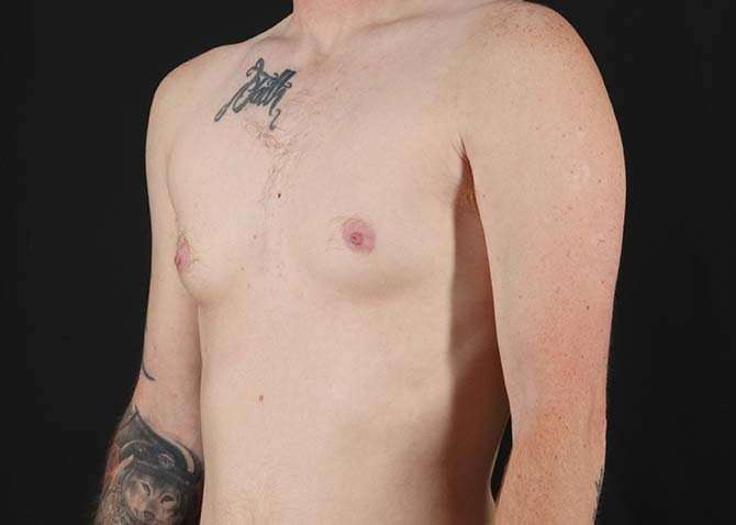 FTM Chest Contouring Before & After Patient #1864