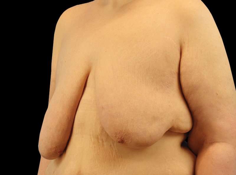 FTM Chest Contouring Before & After Patient #1875