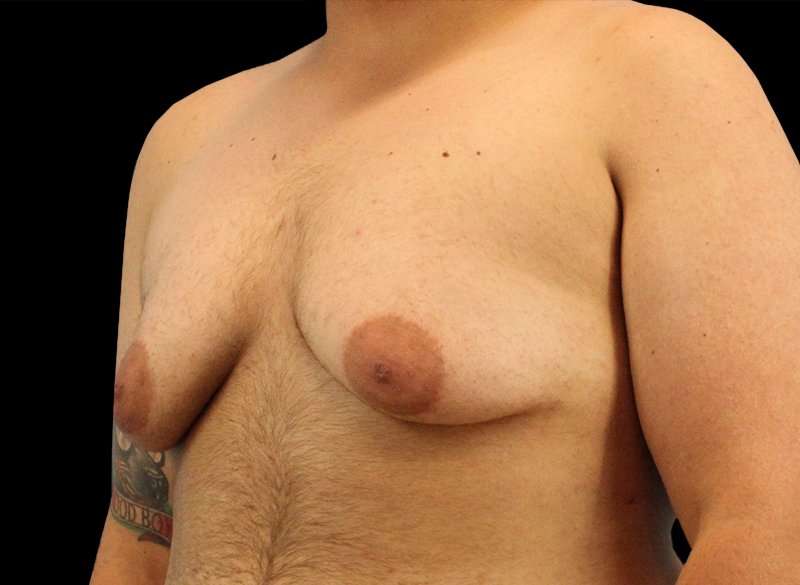 FTM Chest Contouring Before & After Patient #1886