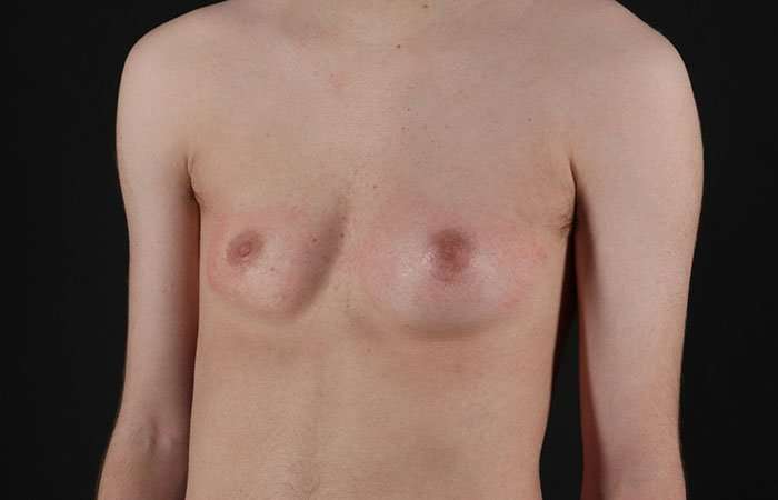 FTM Chest Contouring Before & After Patient #1940