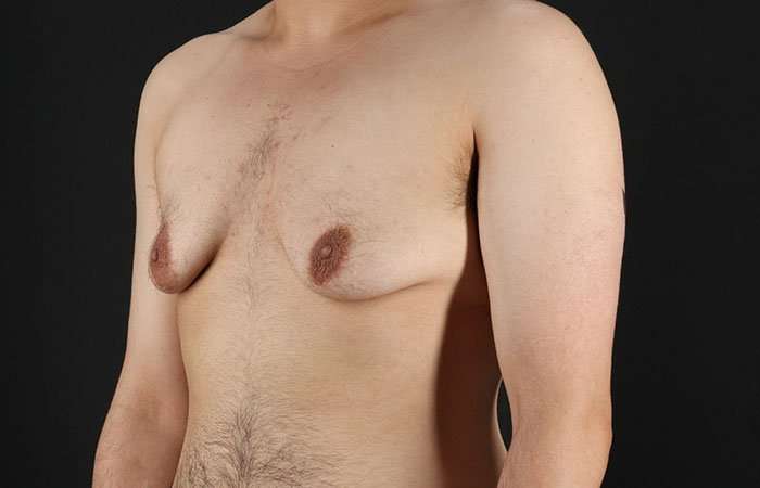 FTM Chest Contouring Before & After Patient #1951