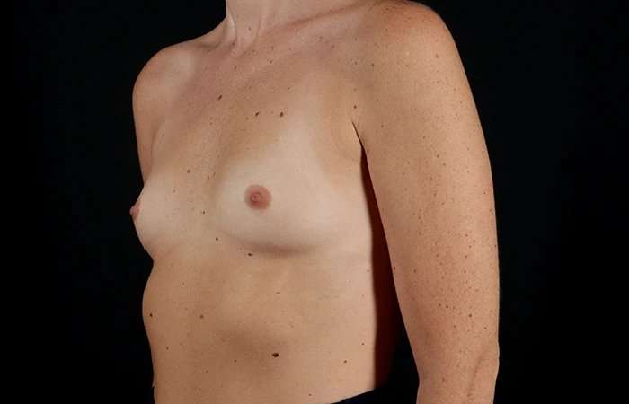 Breast Augmentation - Implant Before & After Patient #1012