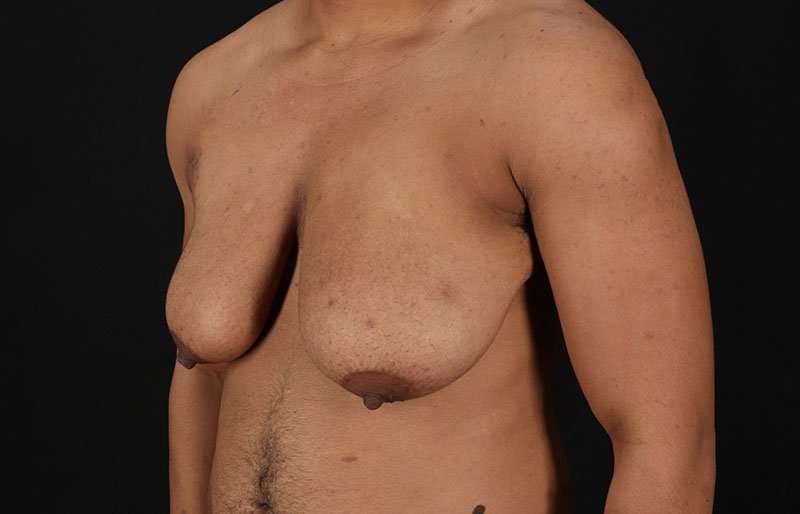 FTM Chest Contouring Before & After Patient #1995