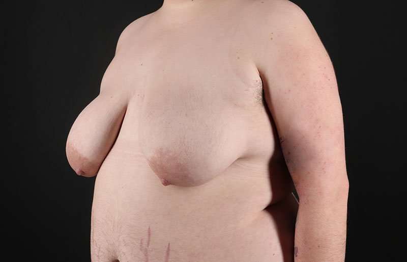 FTM Chest Contouring Before & After Patient #2006