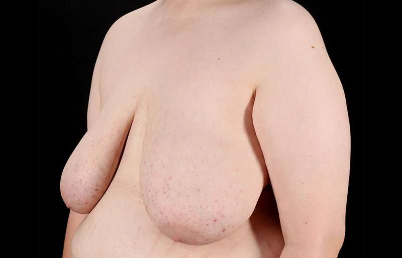 FTM Chest Contouring Before & After Patient #2039