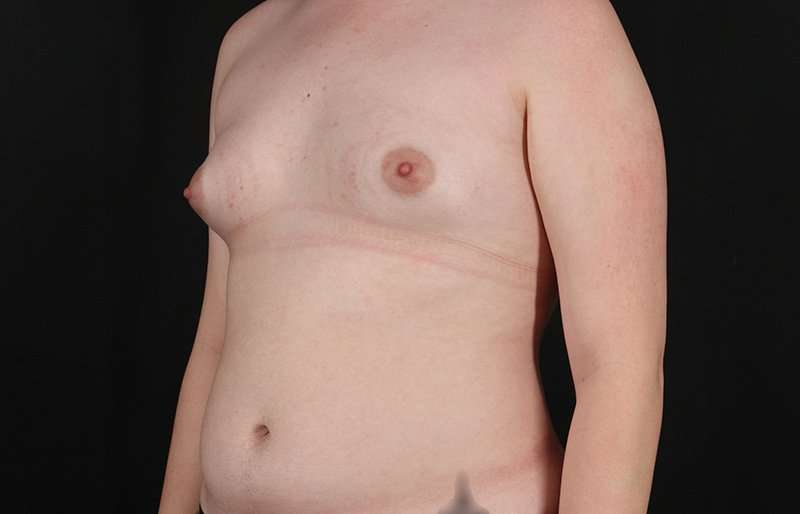FTM Chest Contouring Before & After Patient #2072