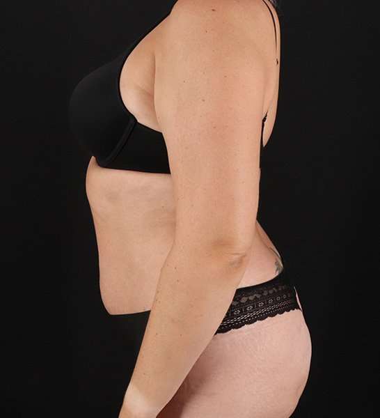 Tummy Tuck Before & After Patient #2128