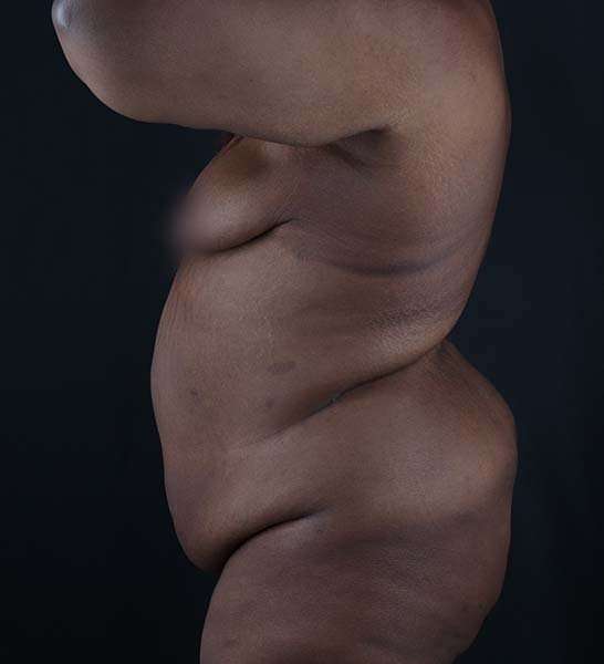 Tummy Tuck Before & After Patient #2139
