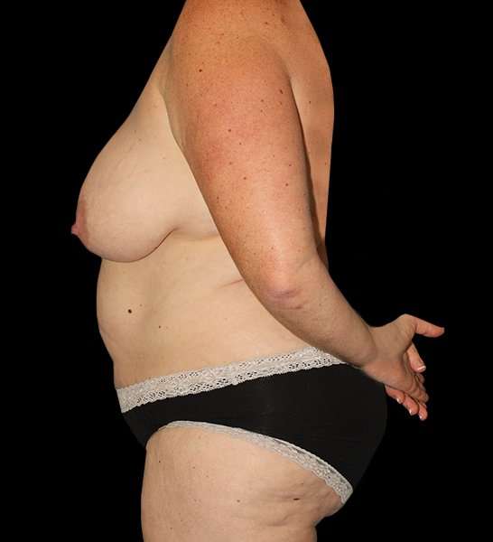 Tummy Tuck Before & After Patient #2157