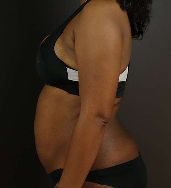 Tummy Tuck Before & After Patient #2168