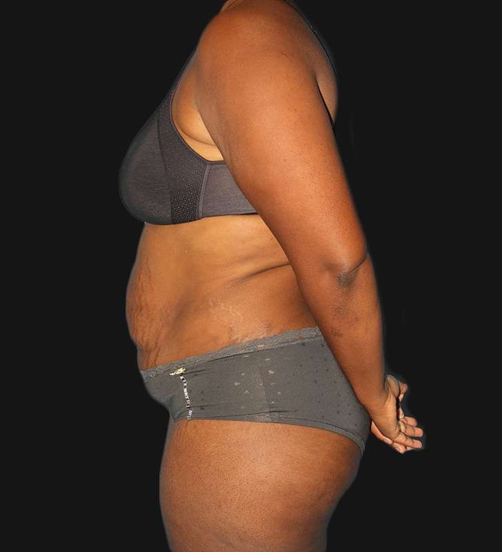 Tummy Tuck Before & After Patient #2179