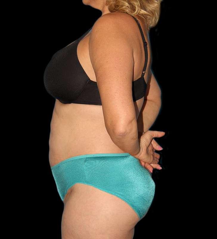 Tummy Tuck Before & After Patient #2190