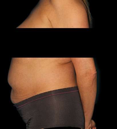 Tummy Tuck Before & After Patient #2201