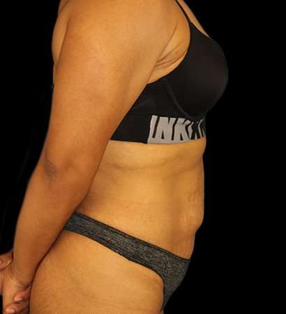 Tummy Tuck Before & After Patient #2212