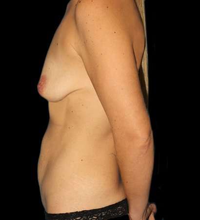 Tummy Tuck Before & After Patient #2223