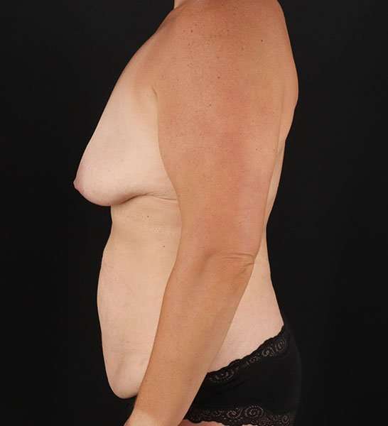 Tummy Tuck Before & After Patient #2247