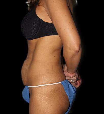 Tummy Tuck Before & After Patient #2269