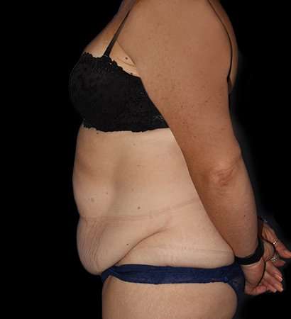 Tummy Tuck Before & After Patient #2280