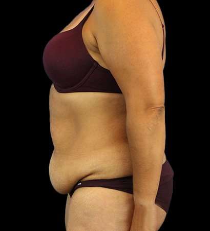 Tummy Tuck Before & After Patient #2291