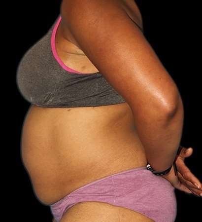 Tummy Tuck Before & After Patient #2302